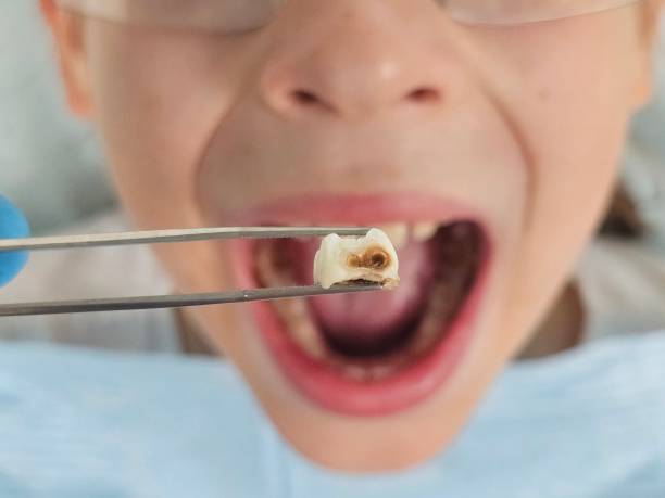 Best Broken or Chipped Tooth Repair in Summit, IL
